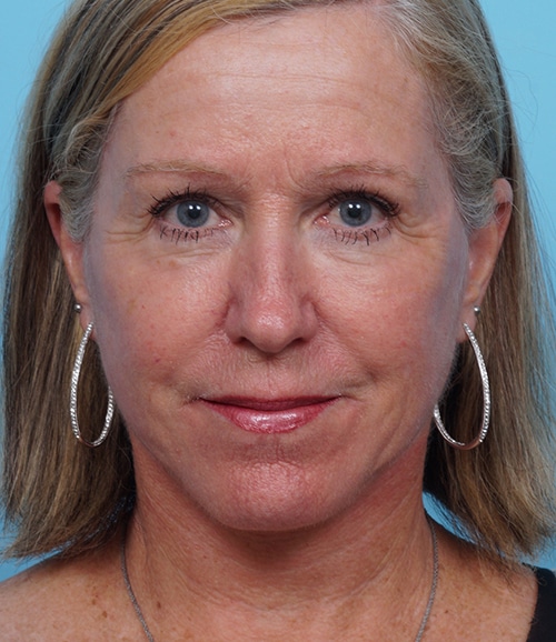 Face Lift/ Mini Lift/ Neck Lift