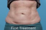 CoolSculpting