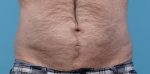 CoolSculpting