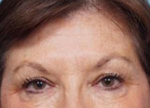 Brow Lift