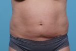 CoolSculpting