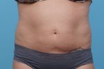 CoolSculpting