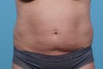 CoolSculpting