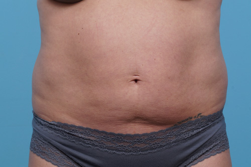 CoolSculpting