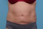 CoolSculpting