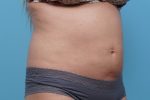 CoolSculpting