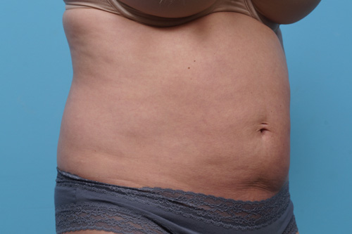 CoolSculpting