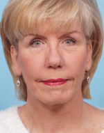 Face Lift/Neck Lift
