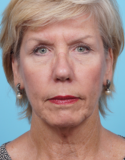 Face Lift/Neck Lift