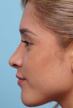 Rhinoplasty