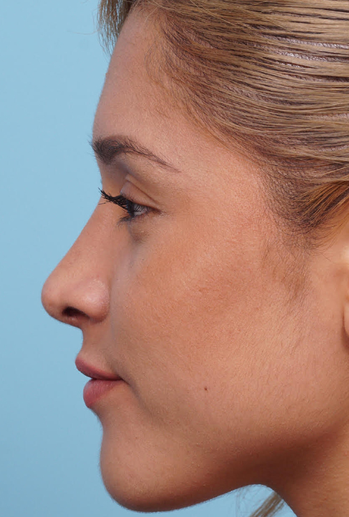 Rhinoplasty