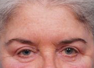 Brow Lift