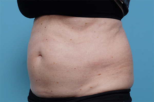 CoolSculpting