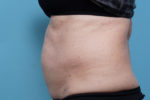 CoolSculpting