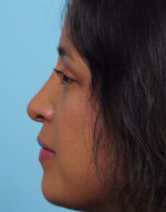 Rhinoplasty