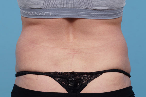 CoolSculpting