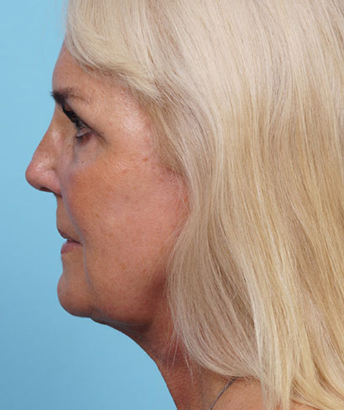 Face Lift/ Mini Lift/ Neck Lift