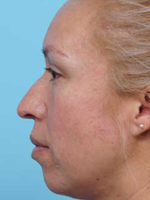 Rhinoplasty