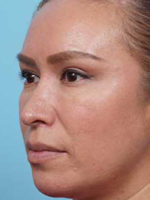 Rhinoplasty