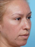 Rhinoplasty