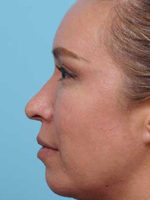 Rhinoplasty