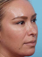 Rhinoplasty