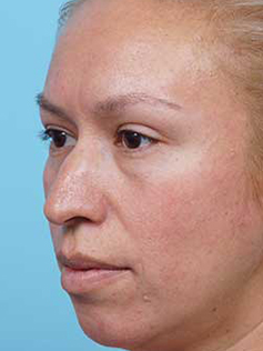 Rhinoplasty