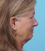 Face Lift/ Mini Lift/ Neck Lift