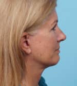 Face Lift/ Mini Lift/ Neck Lift