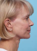 Face Lift/ Mini Lift/ Neck Lift