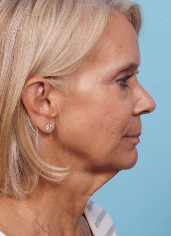 Face Lift/ Mini Lift/ Neck Lift