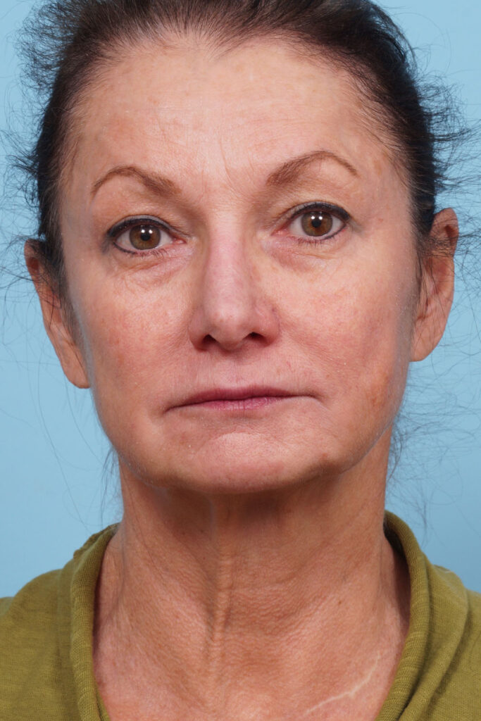 Face Lift/ Mini Lift/ Neck Lift