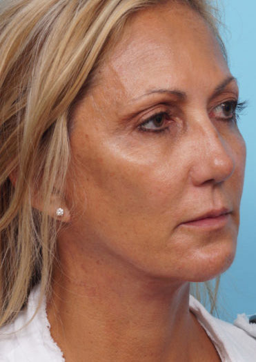 Face Lift/ Mini Lift/ Neck Lift