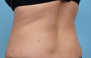 CoolSculpting