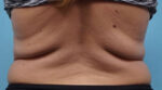 CoolSculpting