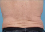 CoolSculpting