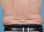 CoolSculpting