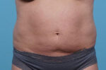 CoolSculpting