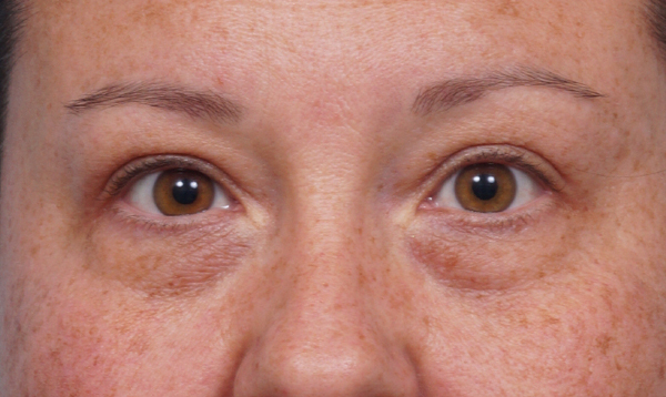 Eye Rejuvenation