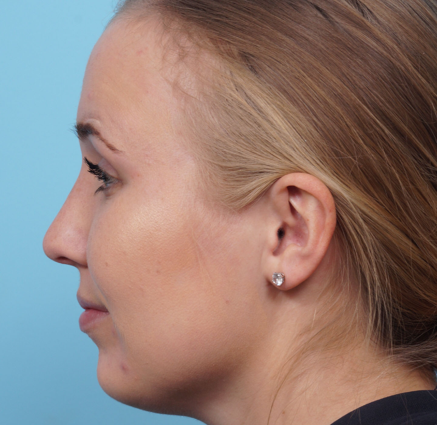 Rhinoplasty