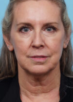 Face Lift/Neck Lift