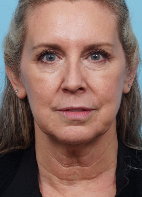 Face Lift/Neck Lift