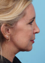 Face Lift/Neck Lift