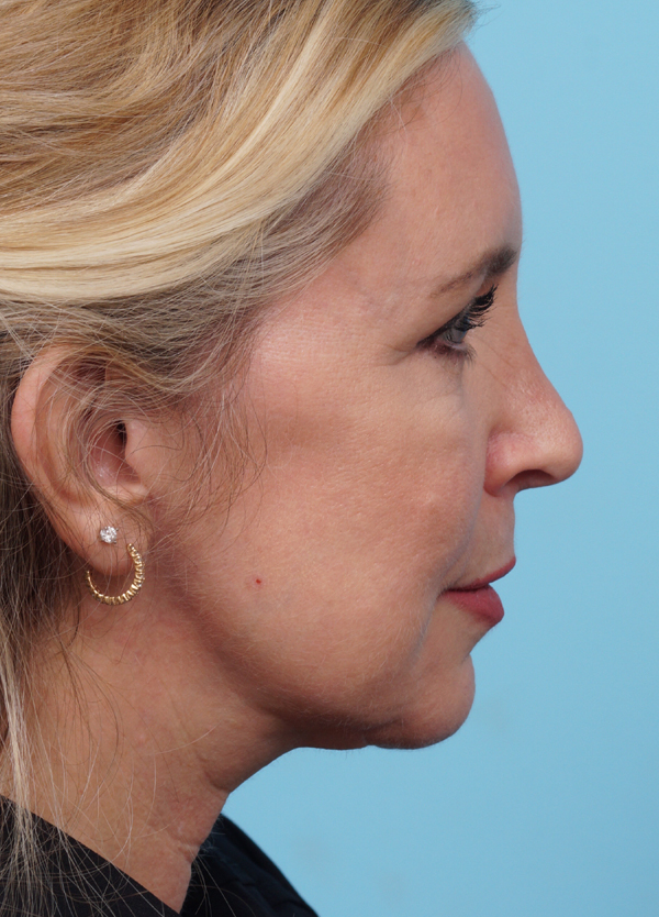 Face Lift/Neck Lift