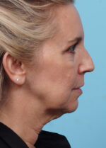 Face Lift/Neck Lift
