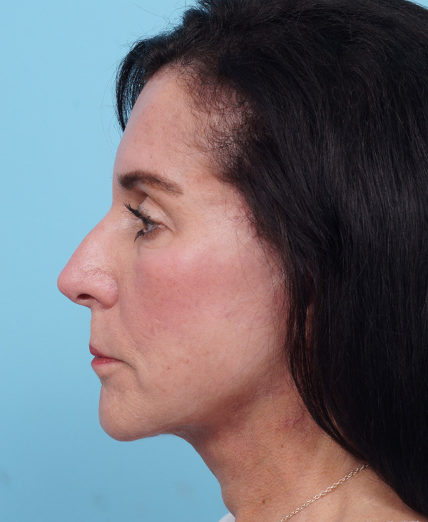 Face Lift/ Mini Lift/ Neck Lift