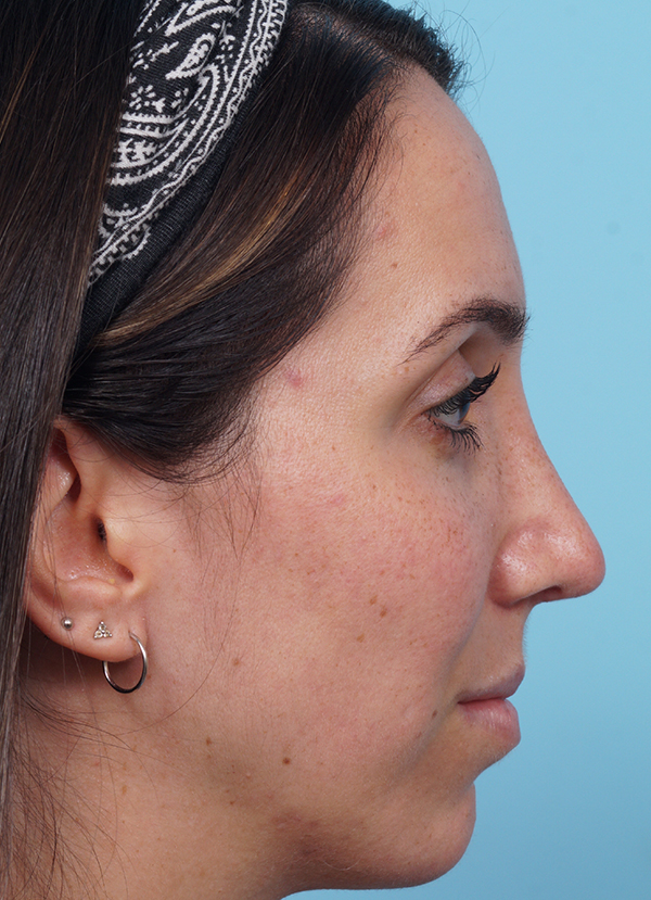 Rhinoplasty