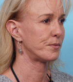 Face Lift/ Mini Lift/ Neck Lift