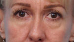 Eye Rejuvenation