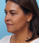 Face Lift/Neck Lift